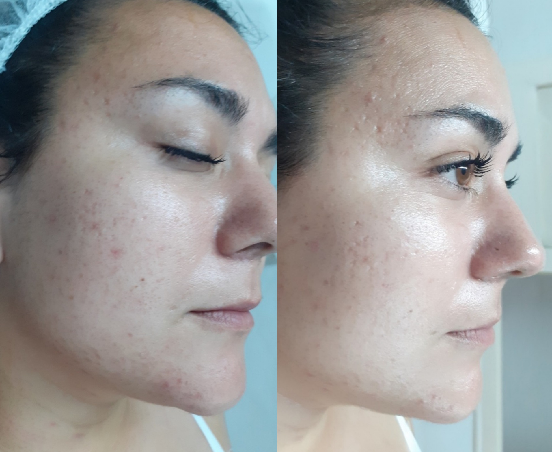 Higiene Facial Avanzada Sabadell